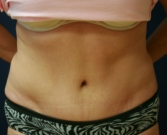 Feel Beautiful - Tummy Tuck Case 17 - After Photo