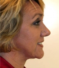 Feel Beautiful - Necklift Case 3 - After Photo