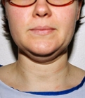 Feel Beautiful - Necklift Case 4 - Before Photo