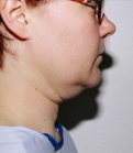 Feel Beautiful - Necklift Case 4 - Before Photo