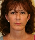 Feel Beautiful - Facelift-San-Diego-Case-2 - After Photo