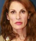 Feel Beautiful - Facelift-San-Diego-Case-23 - Before Photo