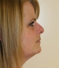 Feel Beautiful - Necklift Case 5 - Before Photo