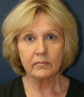 Feel Beautiful - Facelift-Case-25 (no makeup after 8 weeks) - Before Photo