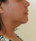 Feel Beautiful - Necklift Case 7 - Before Photo