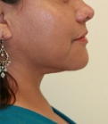 Feel Beautiful - Necklift Case 7 - After Photo