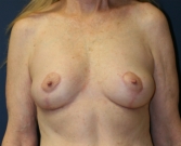 Feel Beautiful - Breast Lift San Diego 21 - After Photo