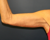 Feel Beautiful - Arm-Lift-San-Diego-7 - After Photo