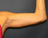 Feel Beautiful - Arm-Lift-San-Diego-8 - After Photo