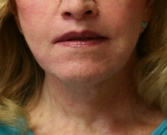 Feel Beautiful - Neck Lift San Diego 21 - After Photo