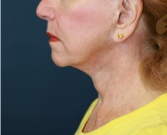 Feel Beautiful - Neck Lift San Diego 21 - Before Photo