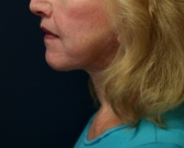 Feel Beautiful - Neck Lift San Diego 21 - After Photo