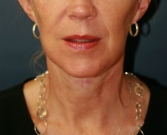 Feel Beautiful - NeckLift San Diego 22 - After Photo