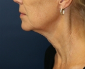 Feel Beautiful - NeckLift San Diego 22 - Before Photo