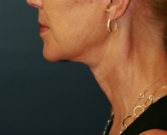 Feel Beautiful - NeckLift San Diego 22 - After Photo