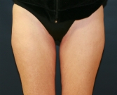 Feel Beautiful - Liposuction Outer Thighs - Before Photo