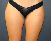 Feel Beautiful - Liposuction Inner and Outer Thighs - Before Photo