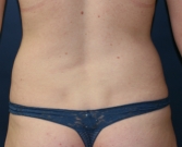 Feel Beautiful - Liposuction Flanks - Before Photo