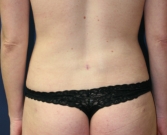 Feel Beautiful - Liposuction Flanks - After Photo