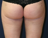 Feel Beautiful - Liposuction Inner and Outer Thighs - After Photo