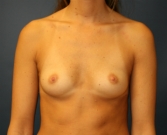 Feel Beautiful - Breast Augmentation San Diego 87 - Before Photo