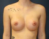 Feel Beautiful - Breast Augmentation San Diego 88 - After Photo