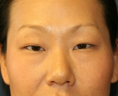 Feel Beautiful - eyelid-surgery-san-diego-66 - Before Photo