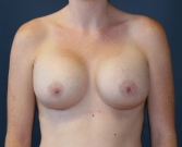 Feel Beautiful - Breast Enlargement San Diego 93 - After Photo