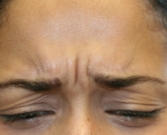 Feel Beautiful - Botox between brows - Before Photo