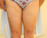 Feel Beautiful - Thigh Lift/Reduction - After Photo