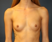 Feel Beautiful - Breast Augmentation San Diego 94 - Before Photo