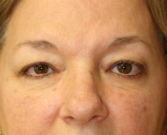 Feel Beautiful - Eyelid Surgery San Diego Case 70 - Before Photo