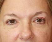 Feel Beautiful - Eyelid Surgery San Diego Case 70 - After Photo