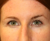 Feel Beautiful - Eyelid Surgery San Diego Case 71 - After Photo