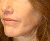 Feel Beautiful - Laser Skin Renewal San Diego 8 - After Photo