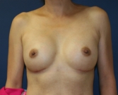 Feel Beautiful - Breast Implants San Diego 96 - After Photo