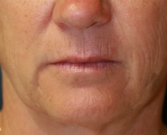 Feel Beautiful - Laser Skin Around Lips - Before Photo