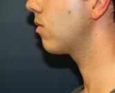 Feel Beautiful - Chin Implant San Diego - Before Photo
