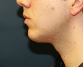 Feel Beautiful - Chin Implant San Diego - After Photo