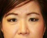 Feel Beautiful - Double Eyelid Procedure (Upper & Lower) - Before Photo
