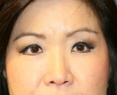 Feel Beautiful - Double Eyelid Procedure (Upper & Lower) - After Photo