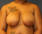 Feel Beautiful - Breast Lift San Diego - Before Photo