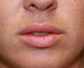 Feel Beautiful - Lip Augmentation with Permalip - Before Photo