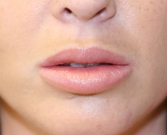 Feel Beautiful - Lip Augmentation with Permalip - After Photo
