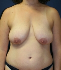 Feel Beautiful - Breast Lift San Diego 24 - Before Photo