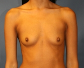 Feel Beautiful - Breast Implants San Diego 99 - Before Photo