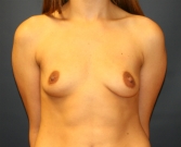 Feel Beautiful - Breast Augmentation San Diego 100 - Before Photo