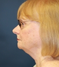 Feel Beautiful - Neck Lift San Diego 24 - Before Photo