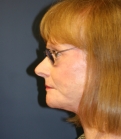 Feel Beautiful - Neck Lift San Diego 24 - After Photo