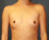 Feel Beautiful - Breast Augmentation Case 12 - Before Photo